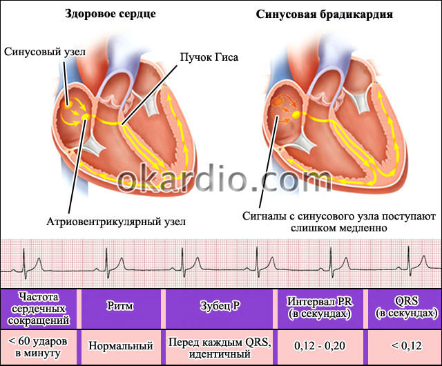 Брадикардия &mdash; причины, симптомы и лечение