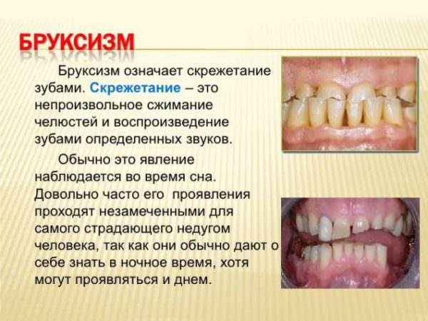 Бруксизм: причины, лечение традиционное и народное