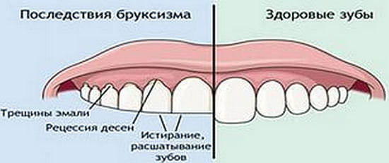 Бруксизм: причины, лечение традиционное и народное