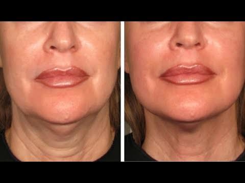 Брыли на лице: что это такое, как убрать, методы и процедуры, упражнения, гимнастика, массаж, чтобы подтянуть в домашних условиях