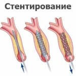 Церебральный склероз головного мозга, симптомы патологии