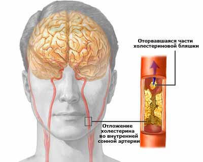 Церебральный склероз головного мозга, симптомы патологии