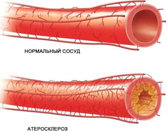 Церебральный склероз головного мозга, симптомы патологии