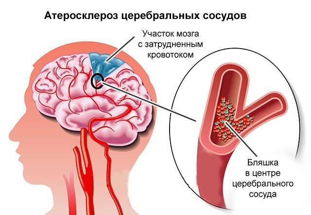 Церебральный склероз головного мозга, симптомы патологии