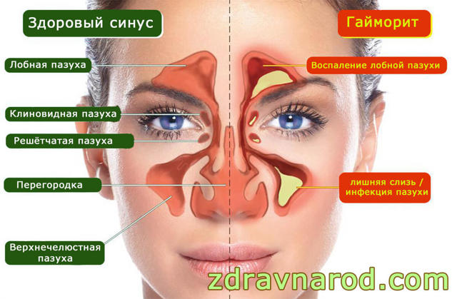 Чем лечить гайморит, если антибиотики не помогают?