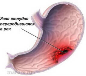 Чем можно понизить температуру при язве желудка?