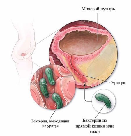 Чем опасен пиелонефрит при беременности для плода