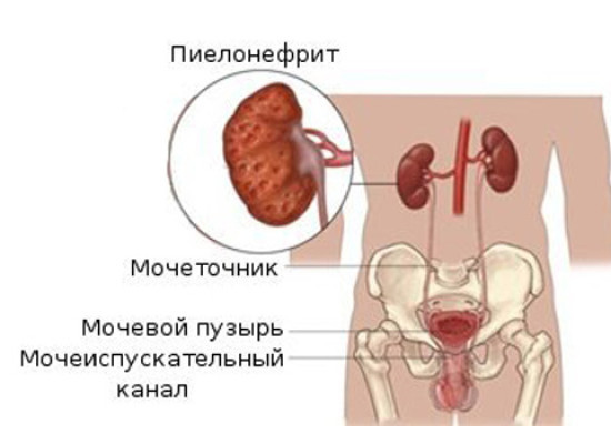 Чем опасен пиелонефрит при беременности для плода