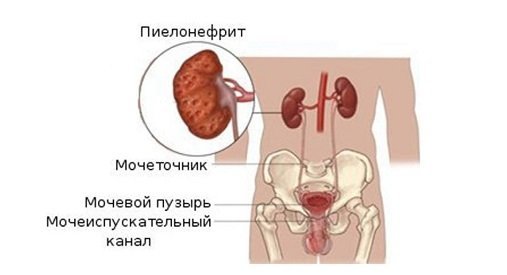 Чем опасен пиелонефрит при беременности для плода