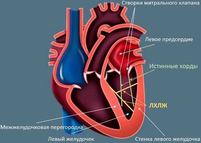 Чем опасна дополнительная хорда в сердце