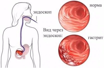 Чем снять боль в подреберье и температуру в 60 лет?