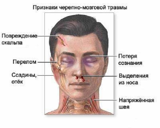 Черепно-мозговая травма — симптомы, первая помощь, последствия