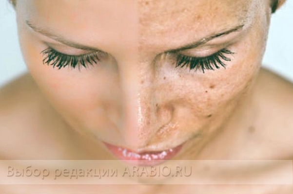 Черные точки на лице, как избавиться от черных точек