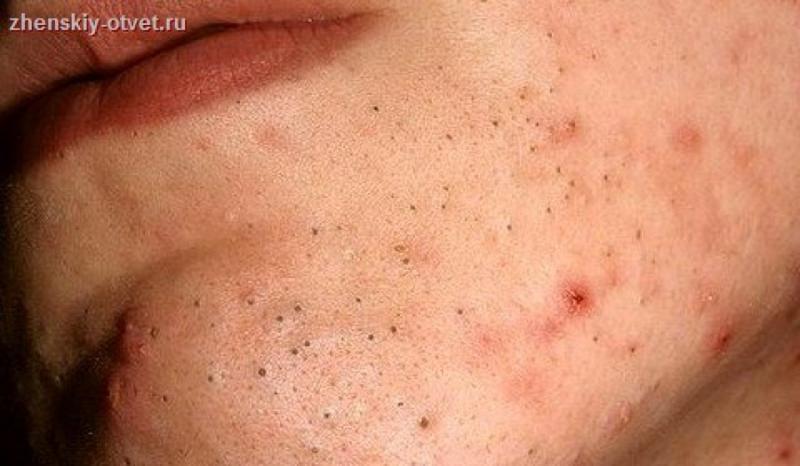 Черные точки на лице, как избавиться от черных точек