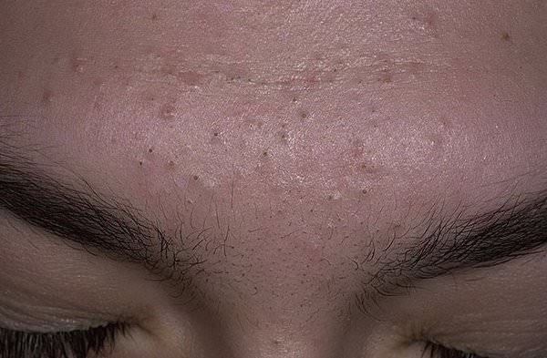 Черные точки на лице, как избавиться от черных точек