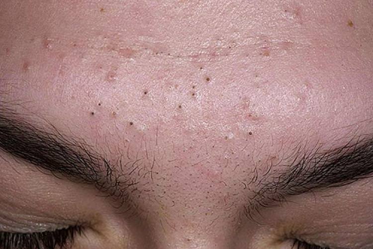 Черные точки на лице, как избавиться от черных точек