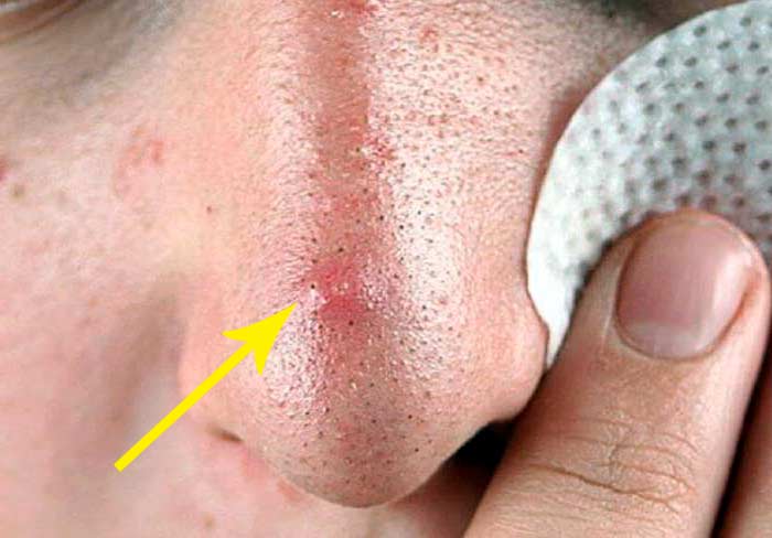 Черные точки на лице, как избавиться от черных точек