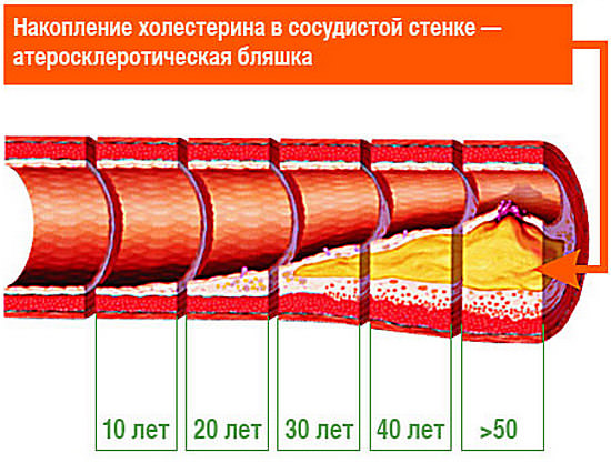 Чистка сосудов народными средствами, рецепты очищения