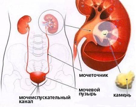 Что делать, если цистон не помог избавиться от камня в почке?