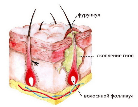 Что делать, если начал созревать фурункул?