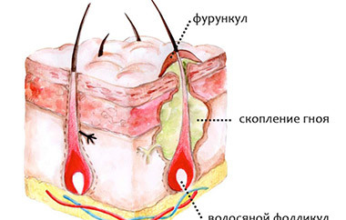 Что делать, если начал созревать фурункул?