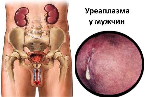 Что делать, если обнаружили уреоплазму, уреалитикум и хламидию?