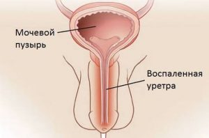 Что делать, если обнаружили уреоплазму, уреалитикум и хламидию?