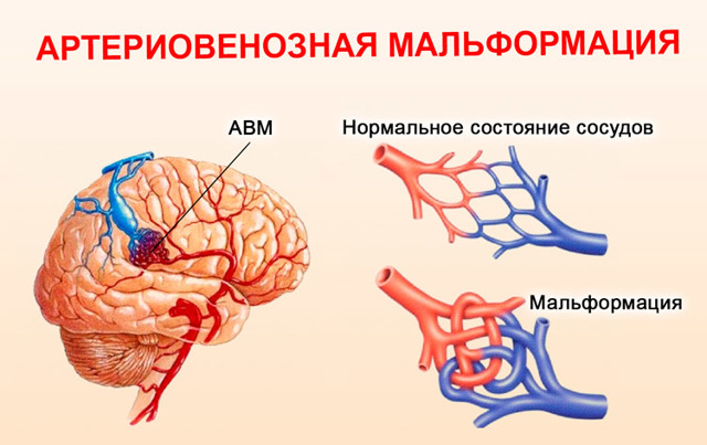 Что делать, если постоянно слышу в ухе звук пульсирующей крови?