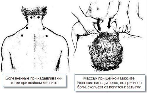 Что делать, если продуло шею: как лечить в домашних условиях, лекарства и народная медицина