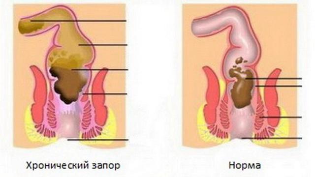 Что делать, если у ребенка запор: лечение запоров у детей, диета при запоре