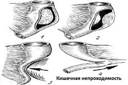 Что делать, если возникают сложности с дефекацией из-за толстого кала?