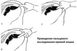 Что делать, если возникают сложности с дефекацией из-за толстого кала?