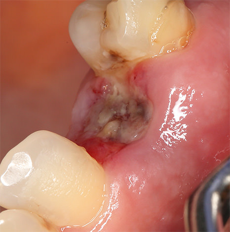 Что делать после удаления зуба, возможные осложнения удаления зубов