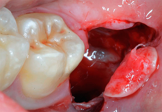 Что делать после удаления зуба, возможные осложнения удаления зубов