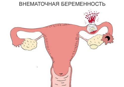 Что делать при сильной колющей боли в правом боку?