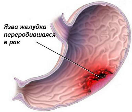 Что делать при возникновении язвы в желудке