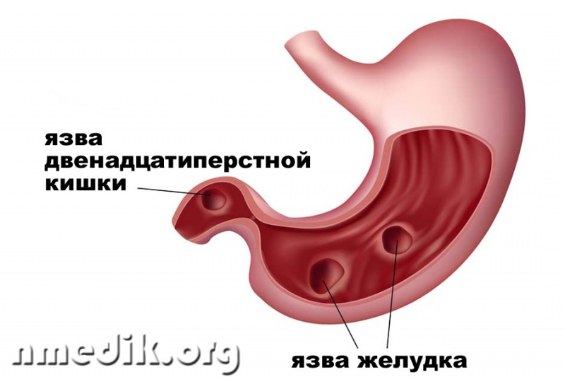 Что делать при возникновении язвы в желудке