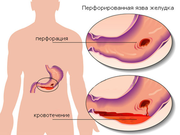 Что делать при возникновении язвы в желудке