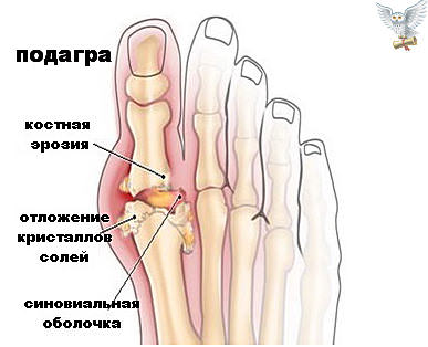 Что это за болезнь подагра — признаки и лечение, причины, диета