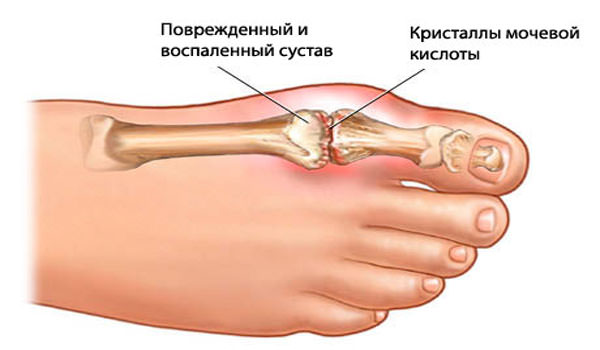 Что это за болезнь подагра — признаки и лечение, причины, диета