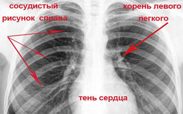 Что означает усиление легочного рисунка на флюорографии