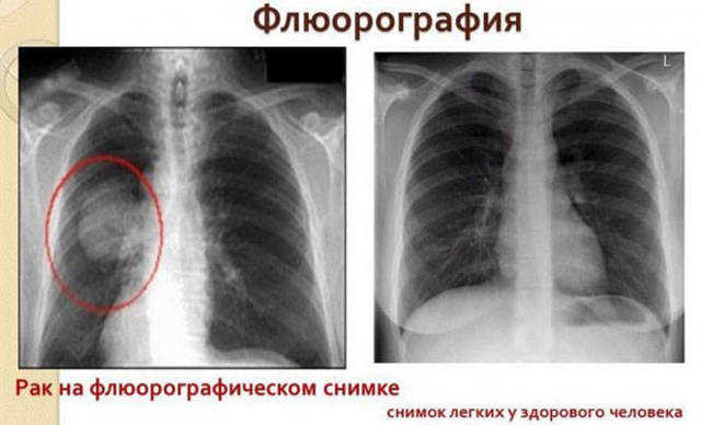 Что означает результат «корни тяжистые» во флюорографии?