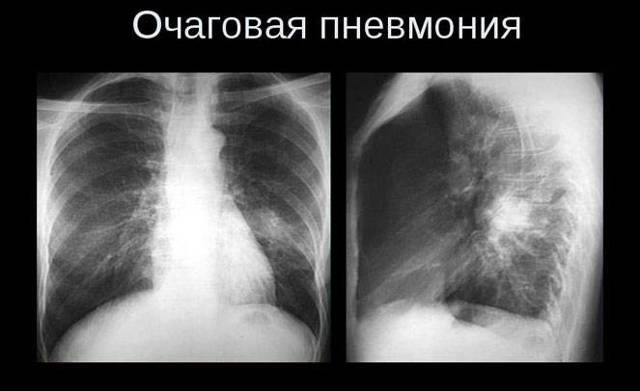 Что означает результат «корни тяжистые» во флюорографии?