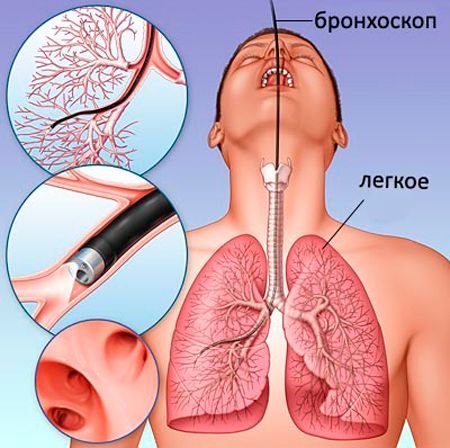 Что означают локальные пневмосклеротические фиброзные изменения в легких?