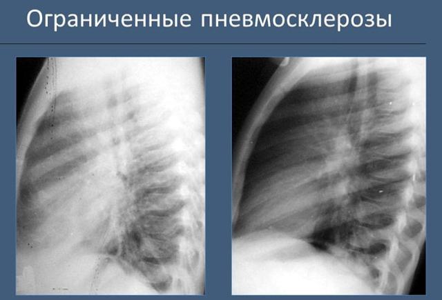 Что означают локальные пневмосклеротические фиброзные изменения в легких?