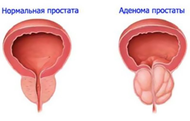 Что предпринять мужчине от частого мочеиспускания мужчине?