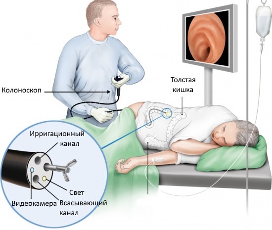 Что следует знать о колоноскопии