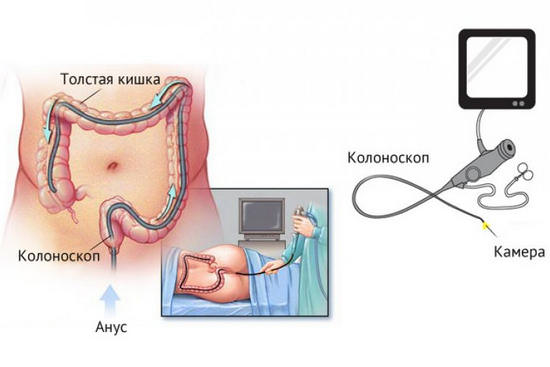 Что следует знать о колоноскопии
