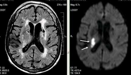 Что такое дисциркуляторная энцефалопатия 1 и 2 степени