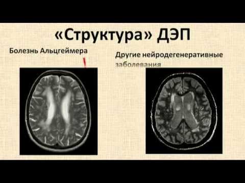 Что такое дисциркуляторная энцефалопатия 1 и 2 степени